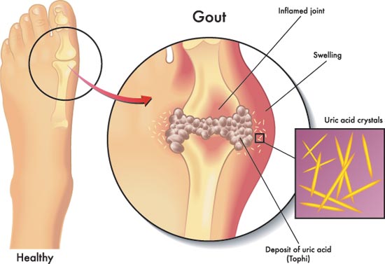Gout Treatments & Preventions | Foot & Ankle Specialists